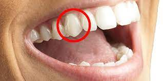 A person's mouth, with a pointy tooth surrounded by a red circle.